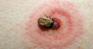 Image of insect on skin with red bulls eye pattern of Lyme Disease